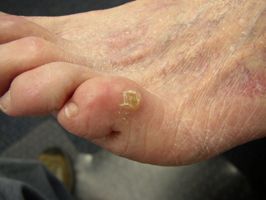 https://propulsionpodiatry.co.uk/test/wp-content/uploads/2020/02/Corn.jpg